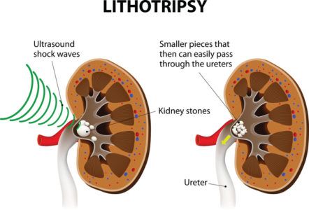 Treatments for stones in the kidney lithotricia 