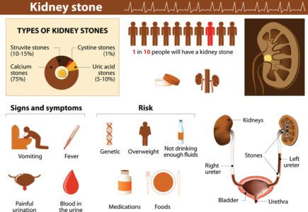 Treatments for the stones in the kidney extraction natural 