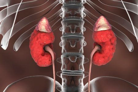 Treatments for kidney stones extract kidney stone